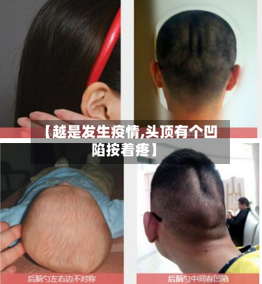 【越是发生疫情,头顶有个凹陷按着疼】-第2张图片