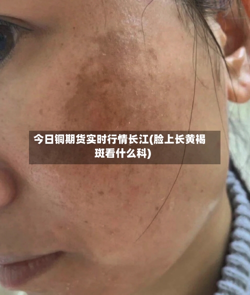 今日铜期货实时行情长江(脸上长黄褐斑看什么科)-第2张图片