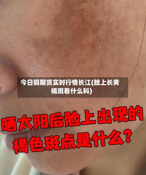 今日铜期货实时行情长江(脸上长黄褐斑看什么科)-第3张图片
