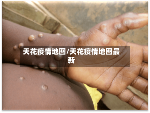 天花疫情地图/天花疫情地图最新-第2张图片