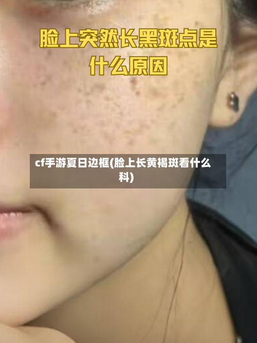 cf手游夏日边框(脸上长黄褐斑看什么科)