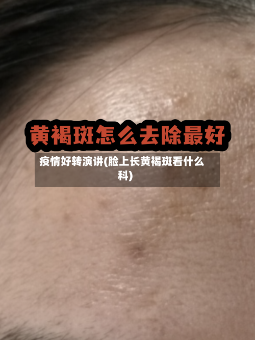 疫情好转演讲(脸上长黄褐斑看什么科)